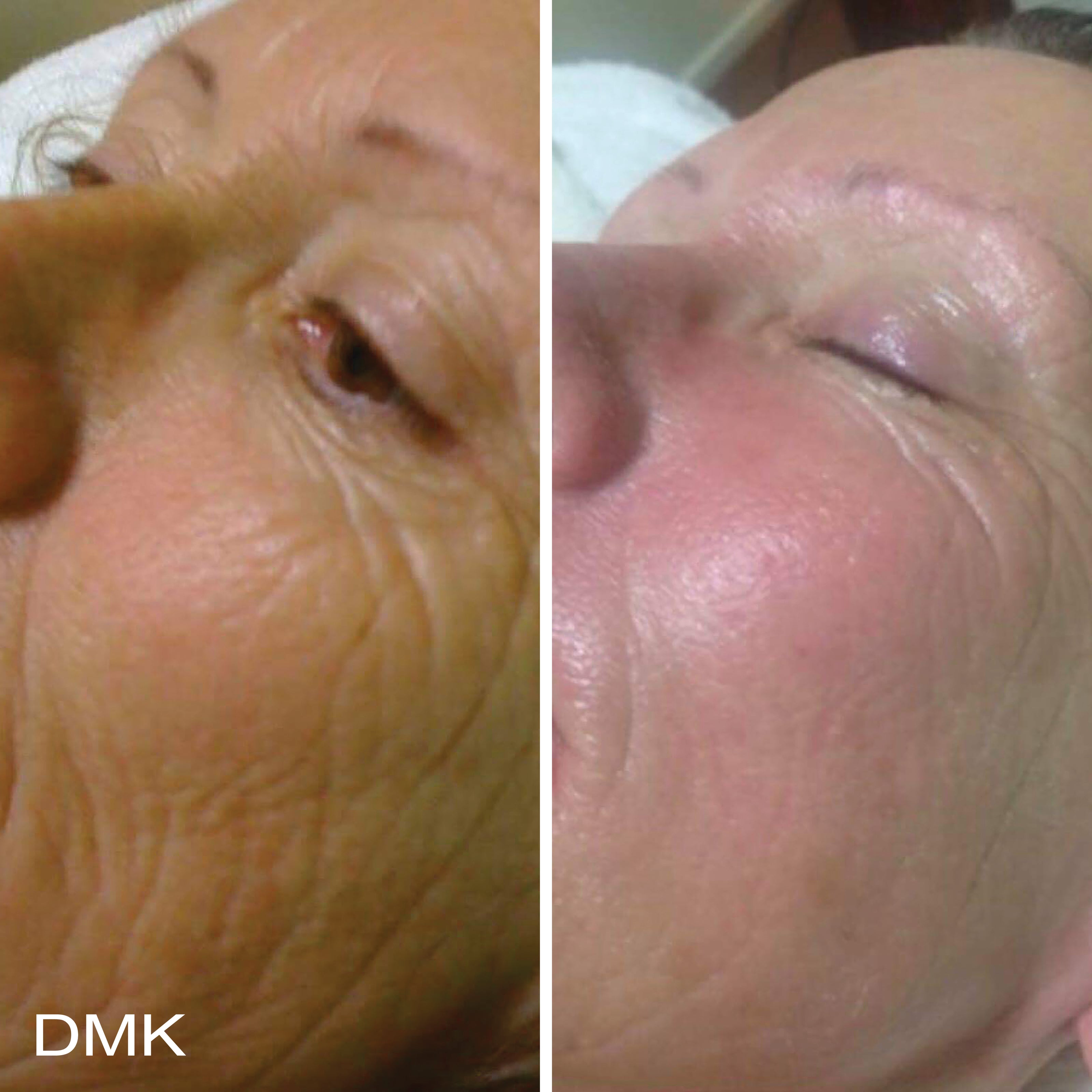 MyDMK_Branded_Before and After Imagery_Ageing_3_300dpi.jpg