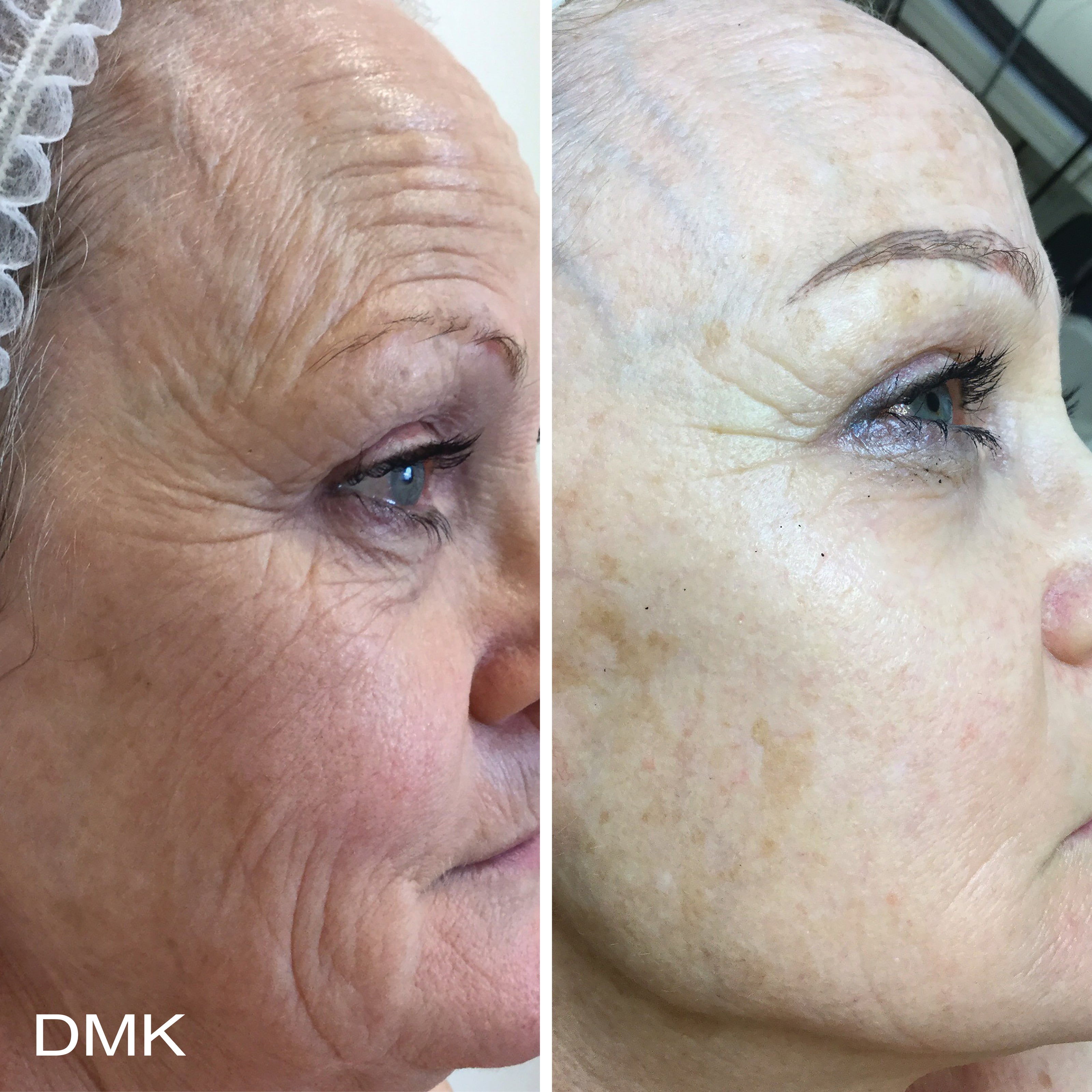 MyDMK_Branded_Before and After Imagery_Ageing_4_300dpi.jpg