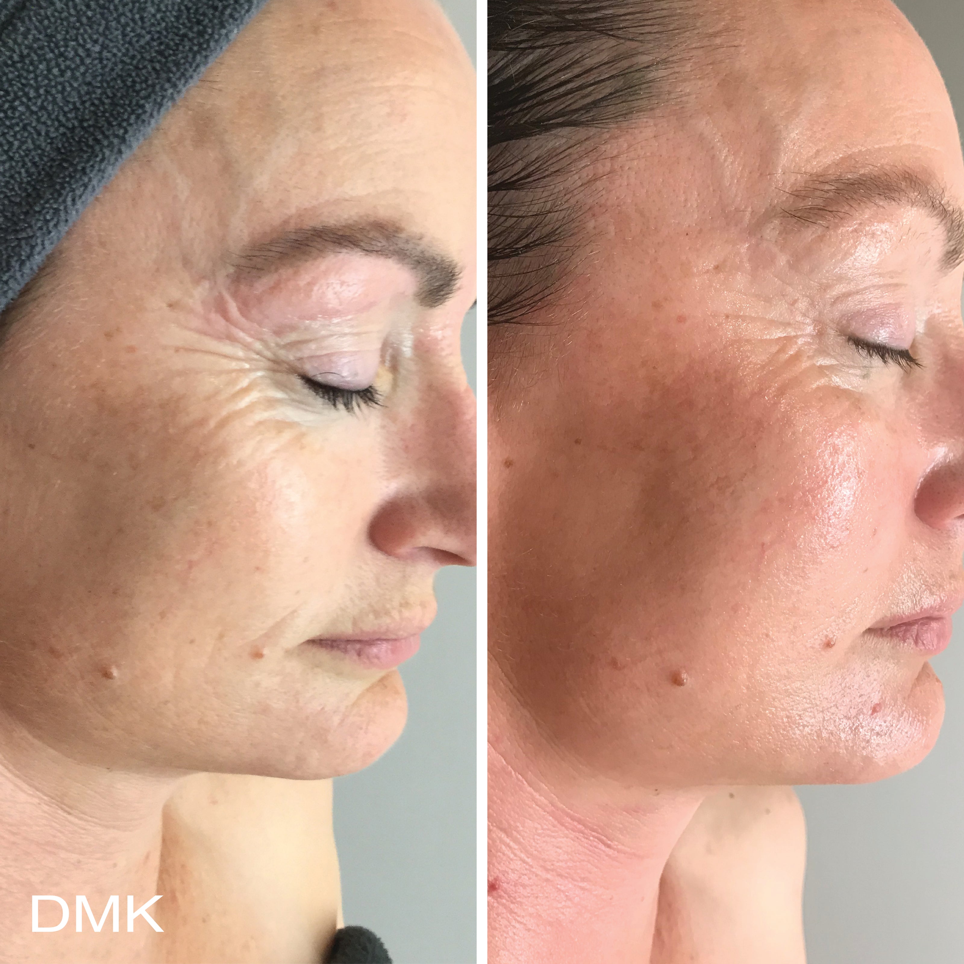 MyDMK_Branded_Before and After Imagery_Ageing_6_300dpi.jpg