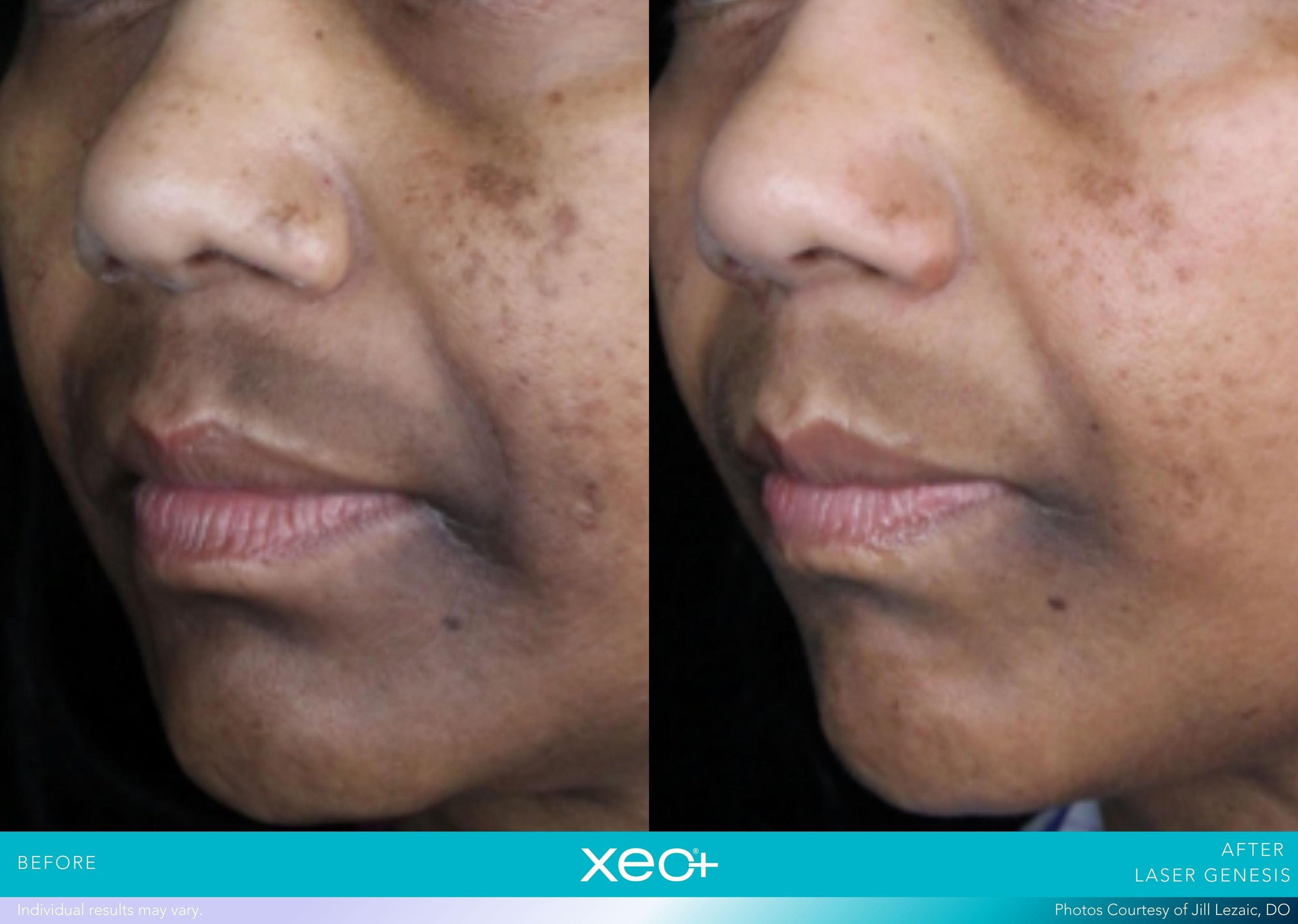 xeoPLUS B&A_lasergen_lezaic1.jpg