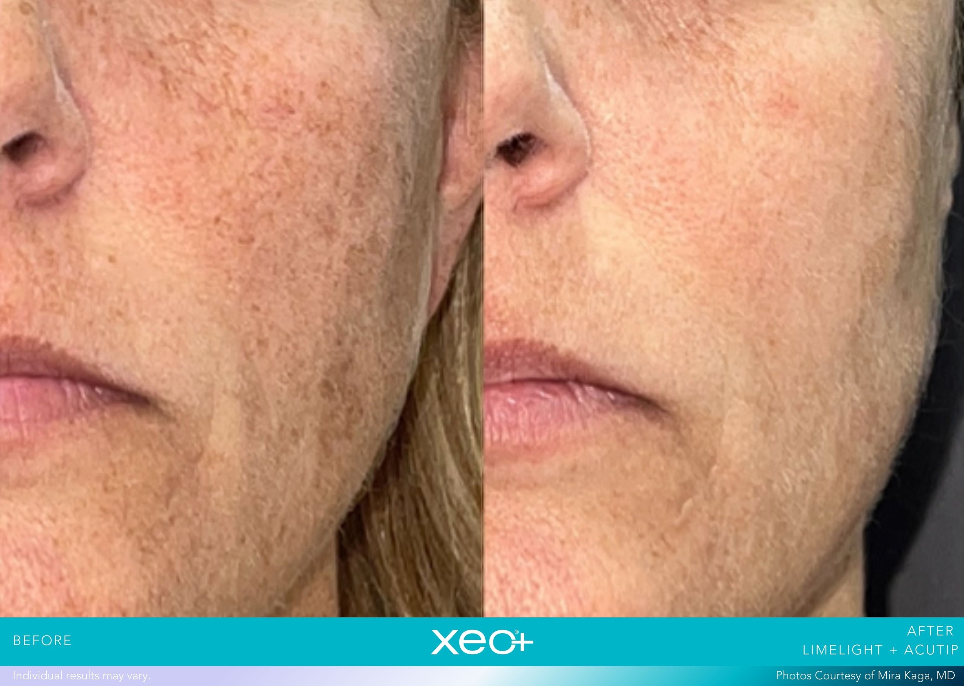 xeoPLUS B&A_limelight-acutip_kaga2.jpg