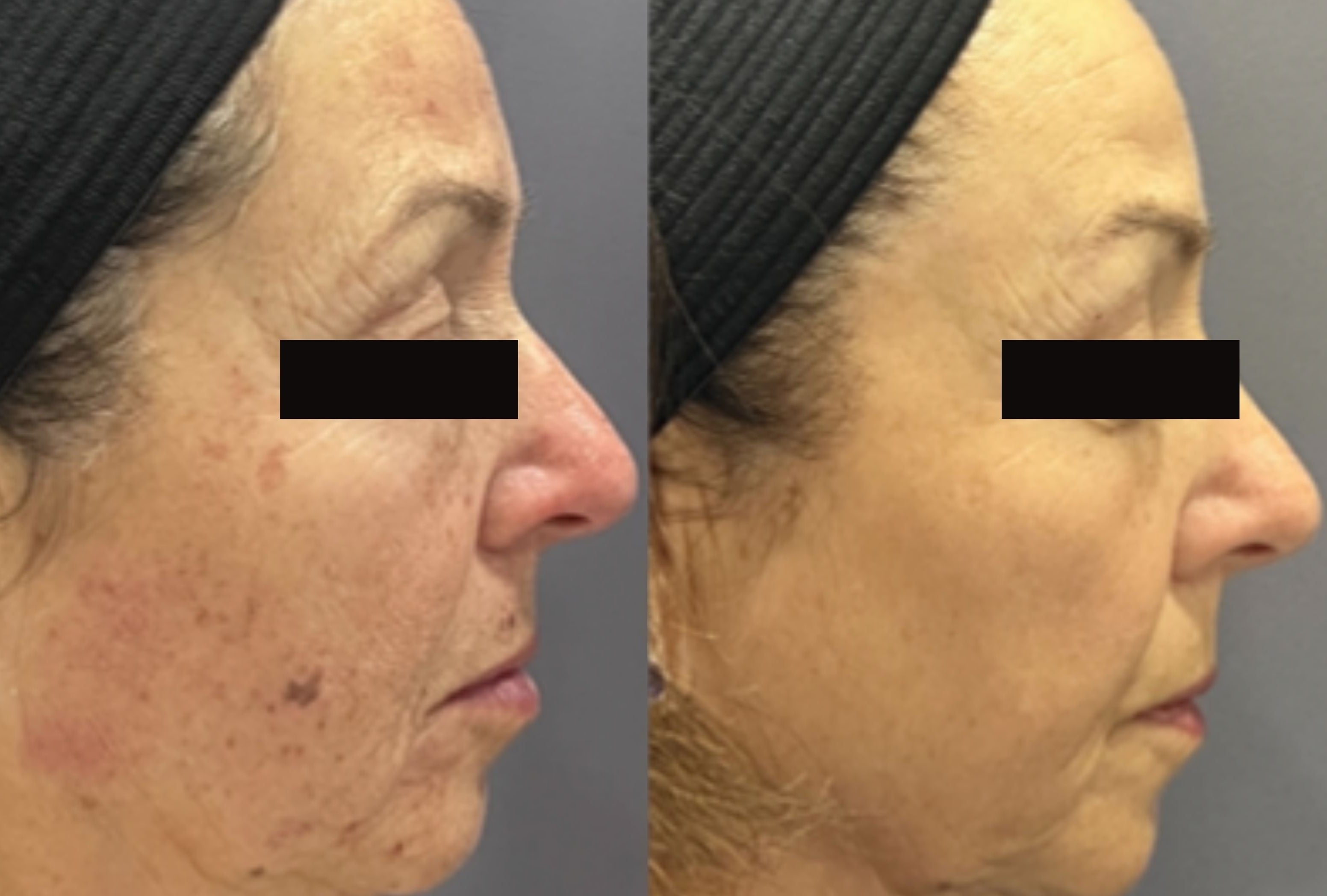 xeoPLUS B&A_limelight-acutip_kaga3_R.jpg