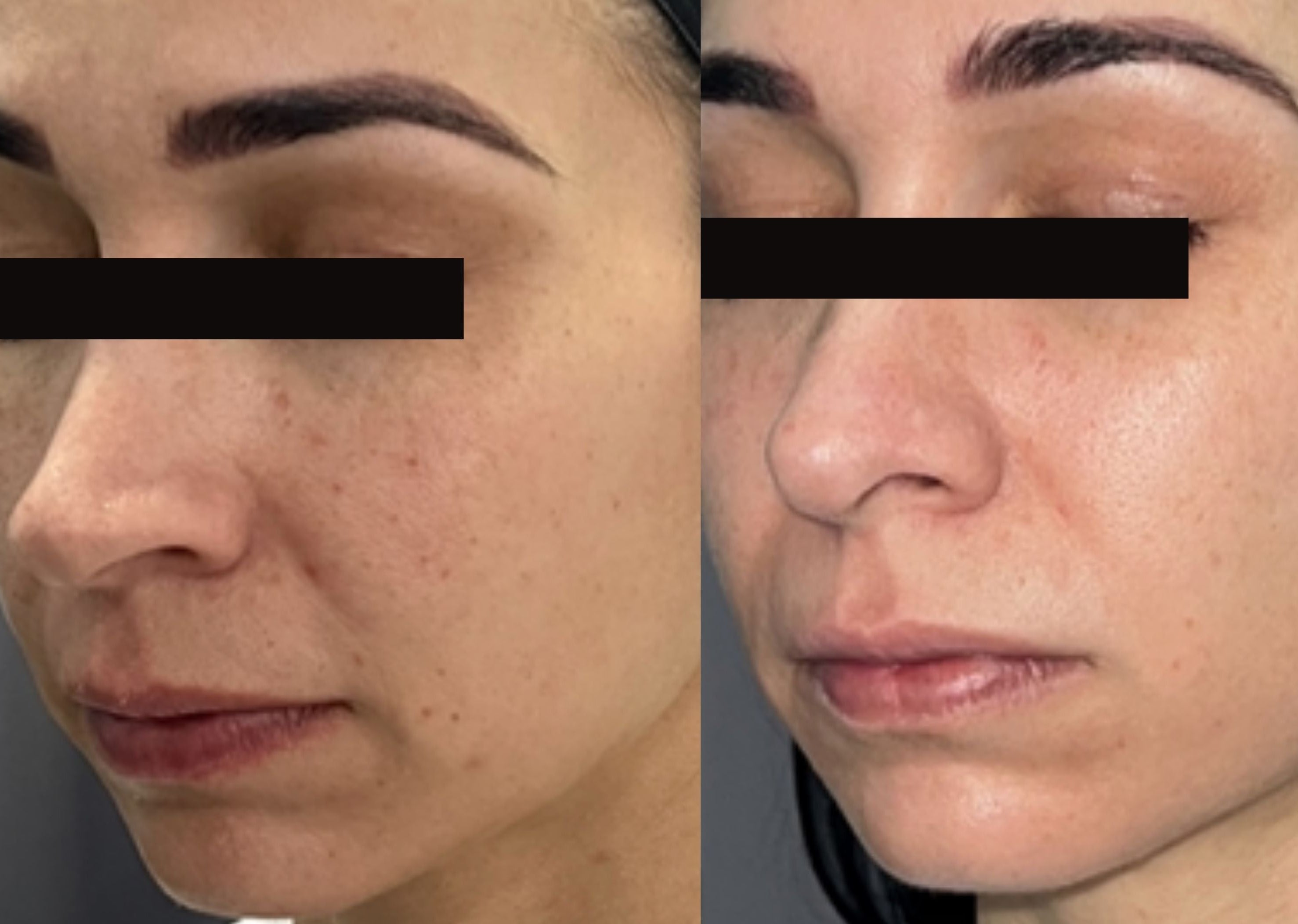 xeoPLUS B&A_limelight-acutip_kaga4.jpg