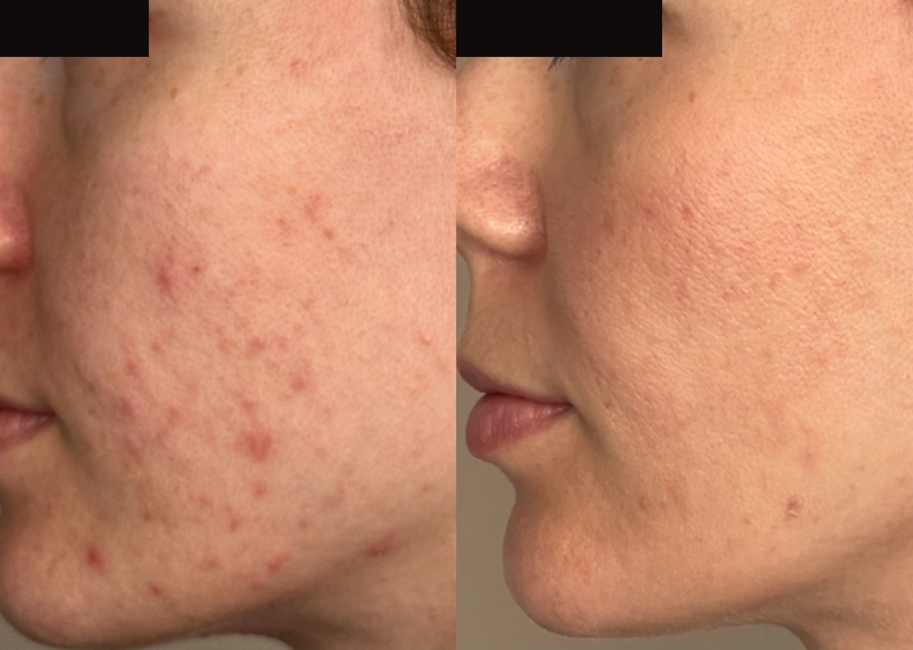 xeoPLUS B&A_limelight-lasergen_desai1_L.jpg